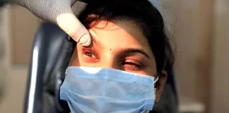 What are the Symptoms of Black Fungus