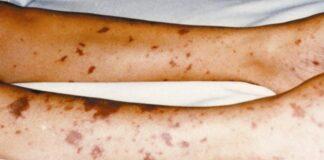 What are the Symptoms of Meningitis Symptoms of Meningitis