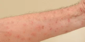 Scabies disease – Causes, Symptoms, Treatment & Medication