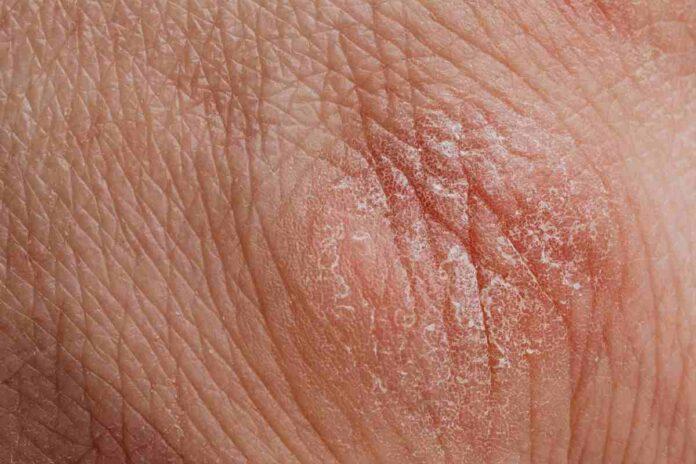 rashes and itchy flaky skin